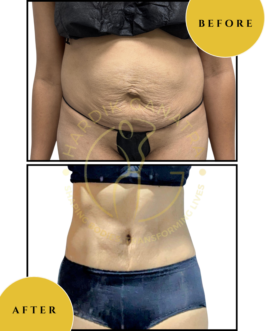 Tummy tuck Diastasis Repair