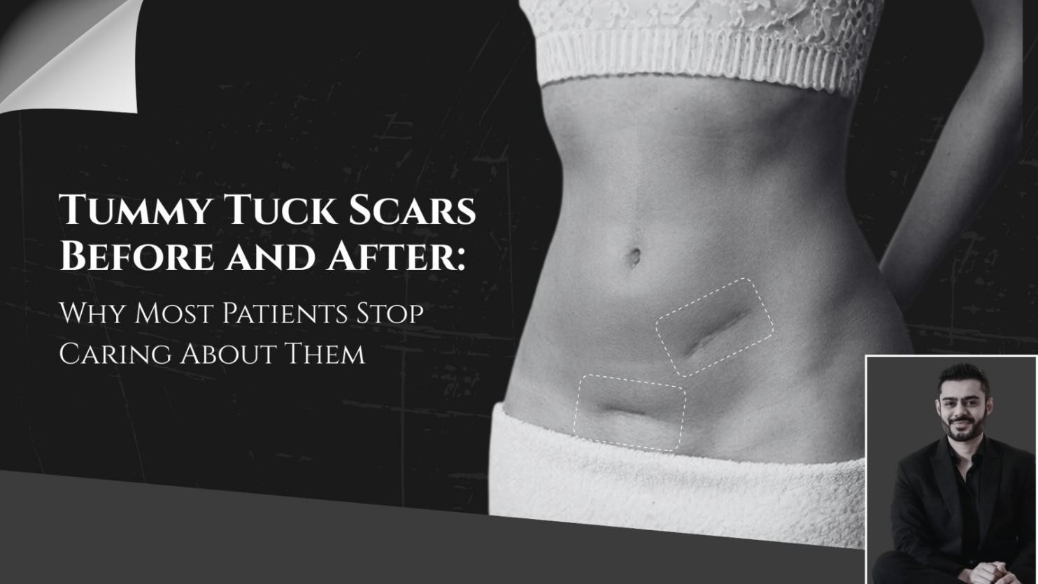 Tummy Tuck Scars Before and After: Why Most Patients Stop Caring About Them