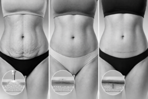 Loose Skin After Liposuction: J-Plasma, Mini Tummy Tuck, or Full Tummy Tuck?