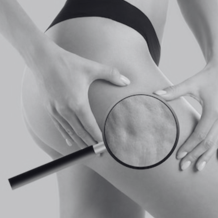 Cellulite treatment (1)
